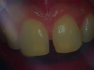 Slight gap between teeth