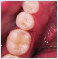 Composite tooth colored fillings