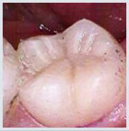 Composite tooth colored filling