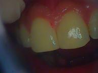 Bonding treatment to cover space between front teeth